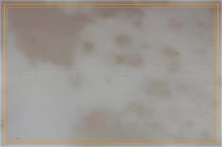 白癜风不治一定面临扩散吗