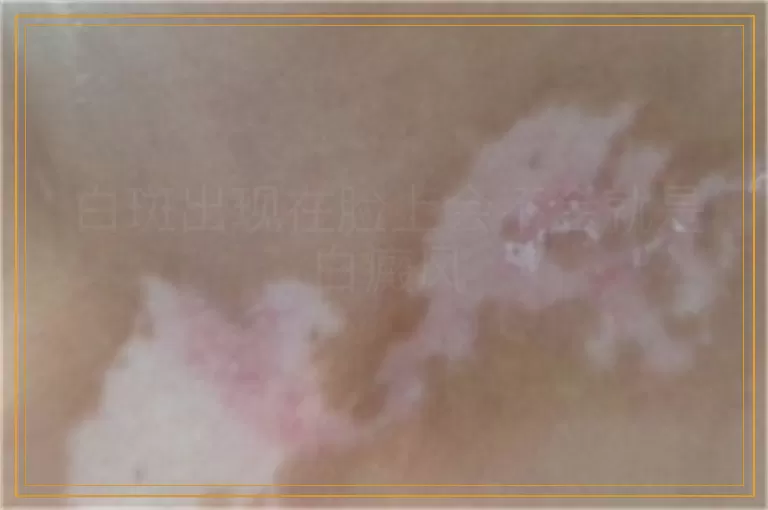 白斑出现在脸上会不会就是白癜风