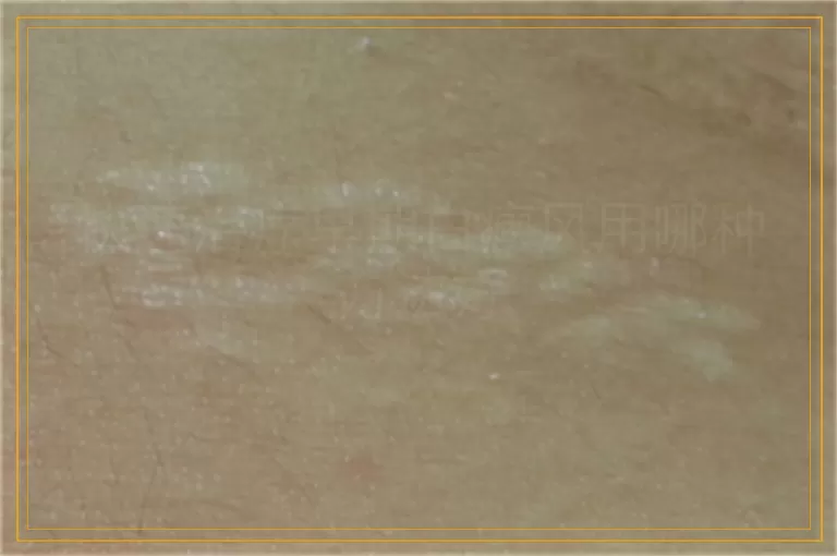 快速治疗早期白癜风用哪种方法好