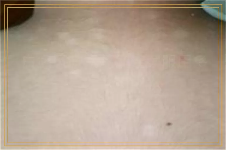 白癜风激素药能连续服用多久