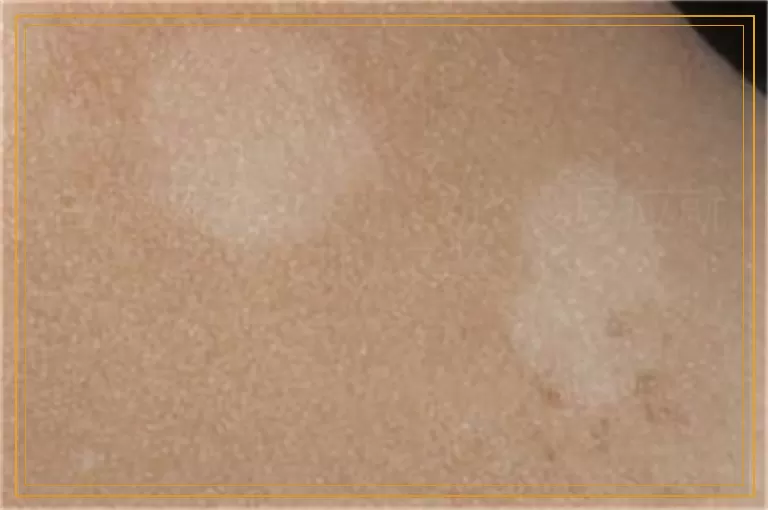 白癜风照308几次还没反应就可以不照