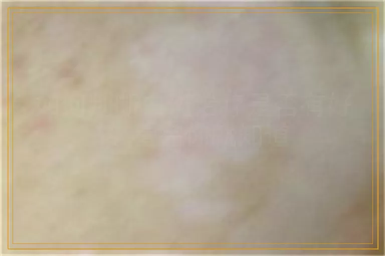 如何判断白斑治疗是否有好转 看完你就知道