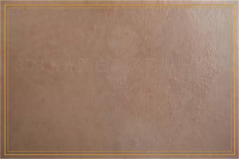 308激光照白癜风可以一直照吗