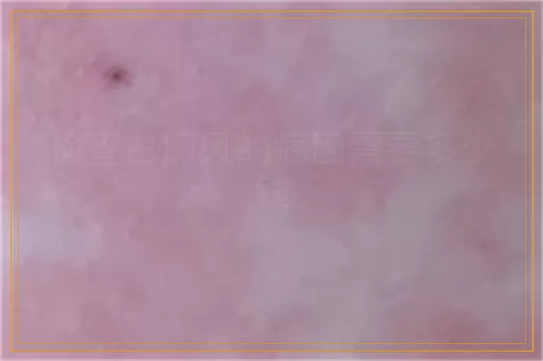 检查白癜风的病因需要多少钱