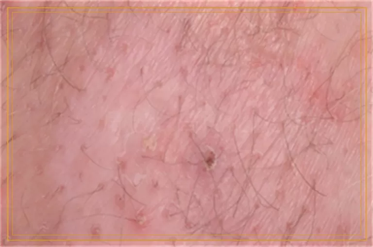 什么偏方治白斑比较有效