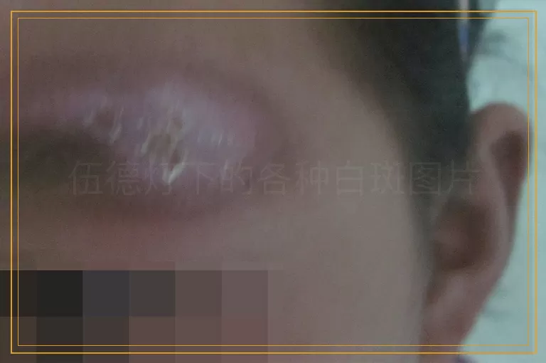 伍德灯下的各种白斑图片