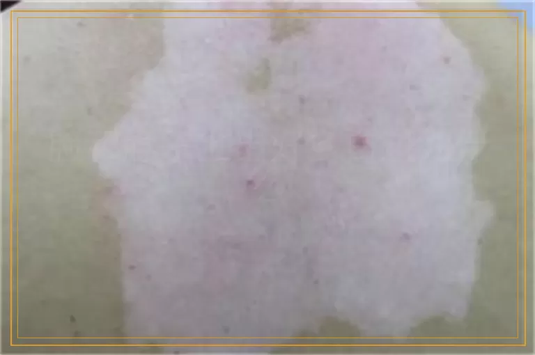 脸和脖子上出好多白斑为什么