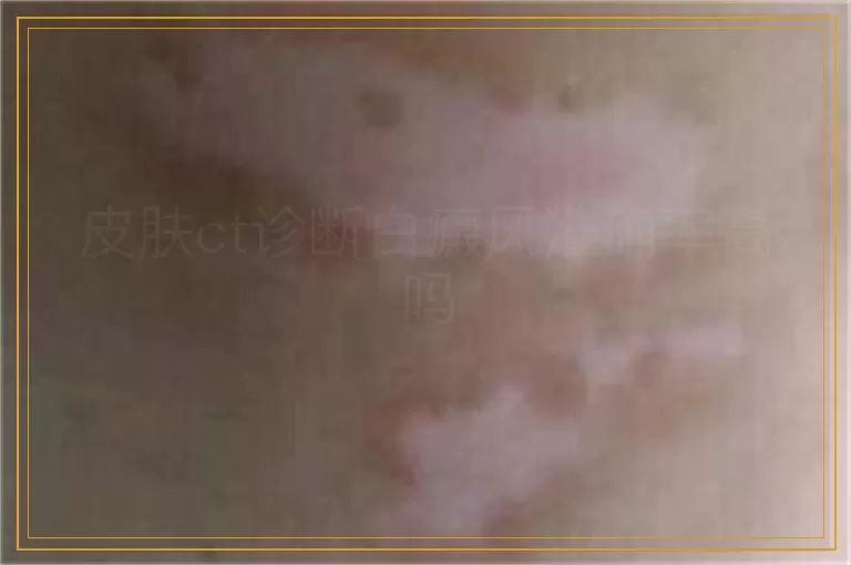 皮肤ct诊断白癜风准确率高吗