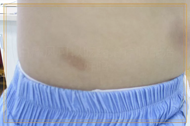 白癜风可以吃药治疗吗能治好吗