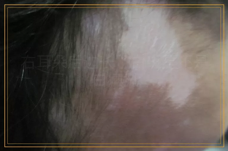 右耳朵后边长了白斑是不是白癜风