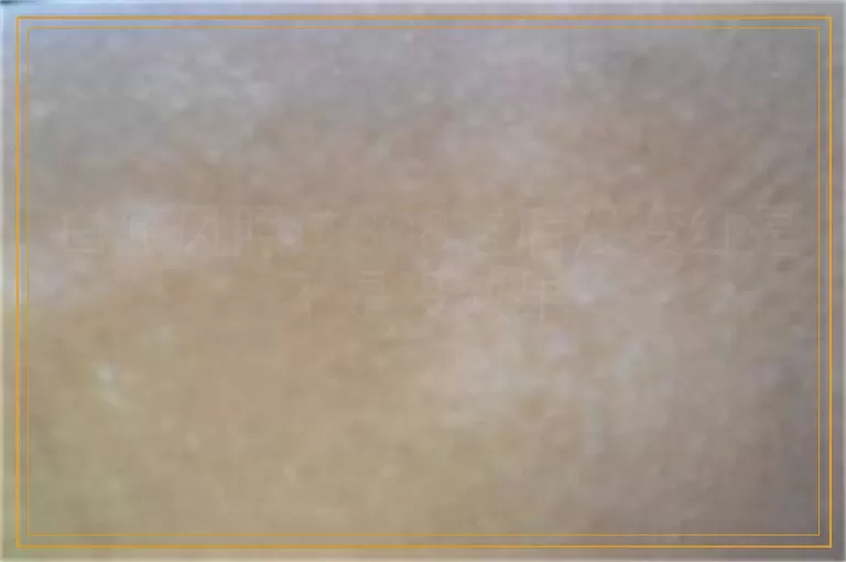 白癜风照过308之后没变红是不是没效果