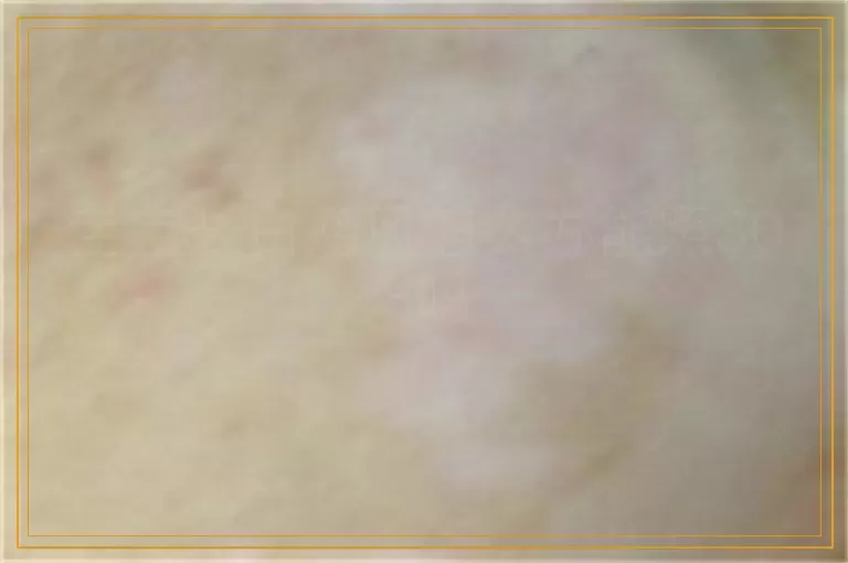 宝宝长白癜风怎么办能照308吗