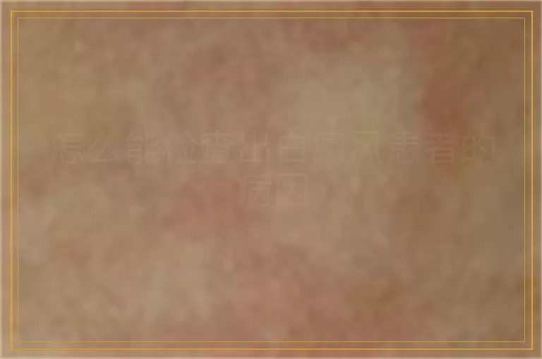 怎么能检查出白癜风患者的病因