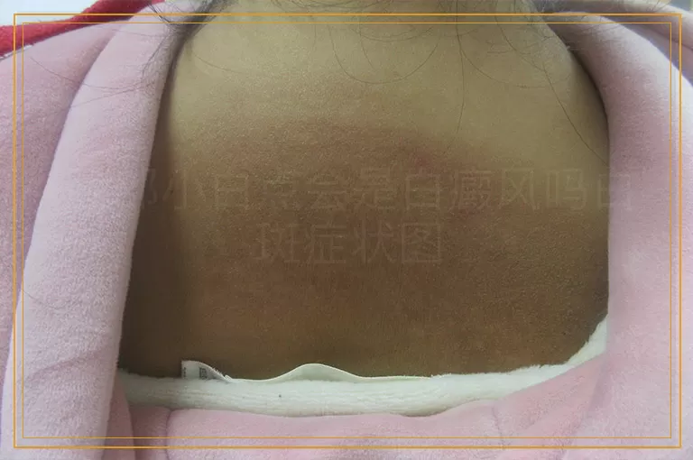 脸部小白点会是白癜风吗白斑症状图