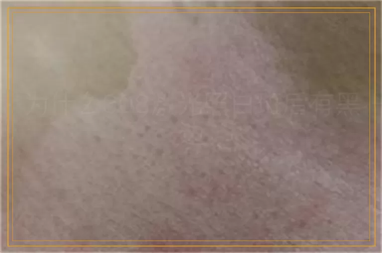 为什么308激光照白斑后有黑边