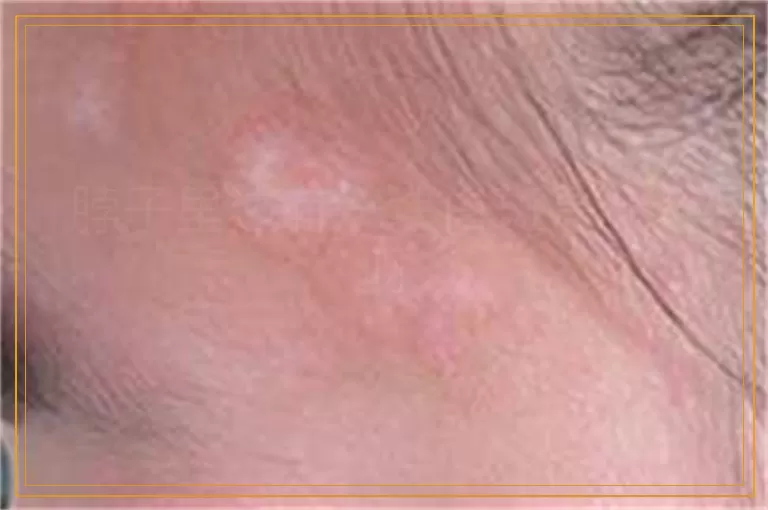 脖子里边有一块白斑是什么呀