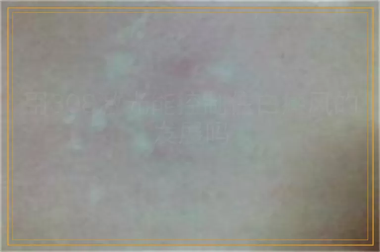 用308激光能控制住白癜风的发展吗