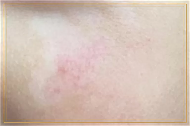 全身白癜风好多年什么方法能治好