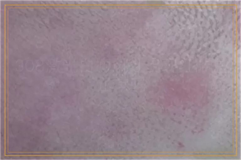 308激光白癜风处出现红肿是正常吗