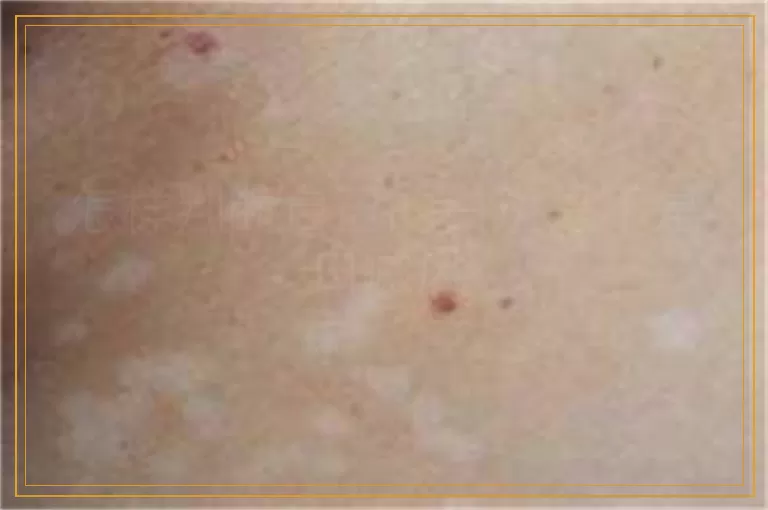 怎样判断自己的白斑是不是白癜风