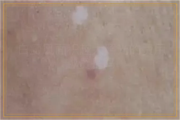 白癜风面积越大照光的费用越贵是吗