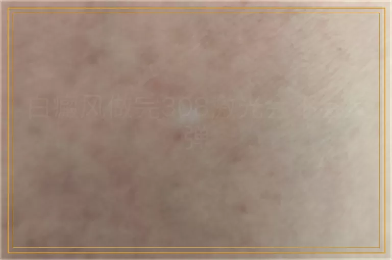 白癜风做完308激光会不会反弹