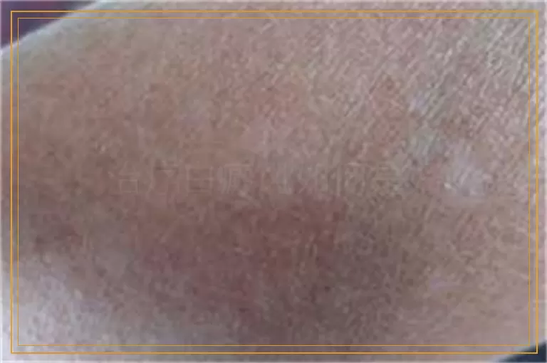 治疗白癜风如何是好