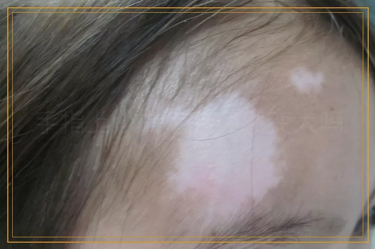 手指上小白点会突然变大吗