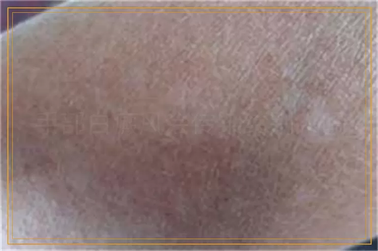 手部白癜风会传染给别人吗