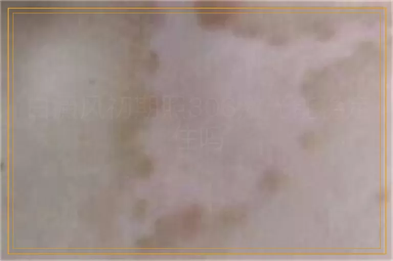 白癜风初期照308激光能稳定住吗