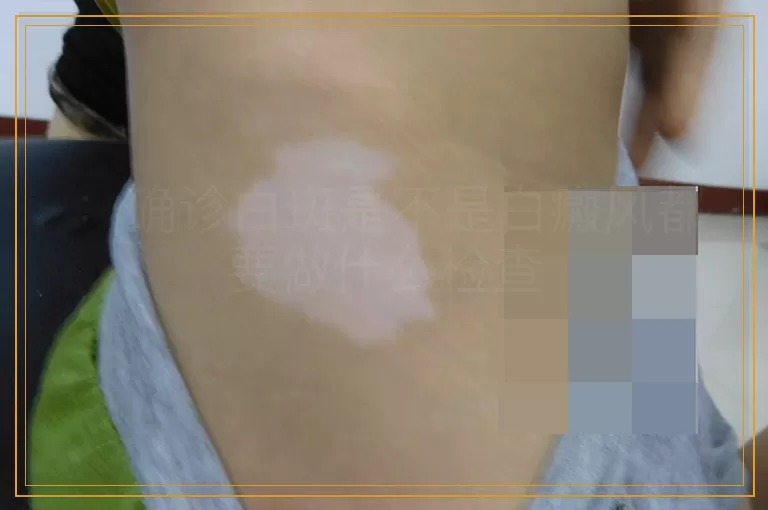 ：确诊白斑是不是白癜风都要做什么检查