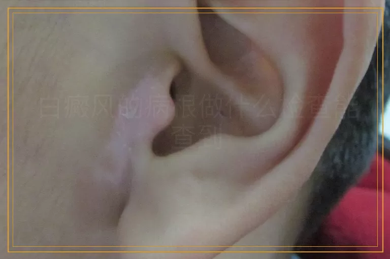 白癜风的病根做什么检查能查到