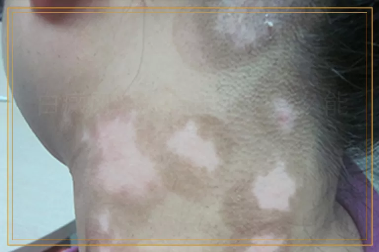 白癜风激光后出水泡多久能在照光