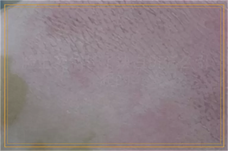 脸上突然长了块白斑怎么引起的