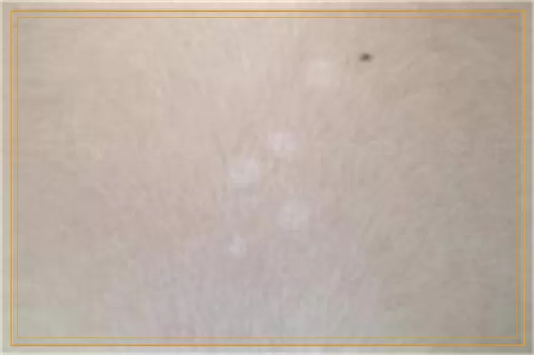 白癜风照308激光一年还没好怎么办