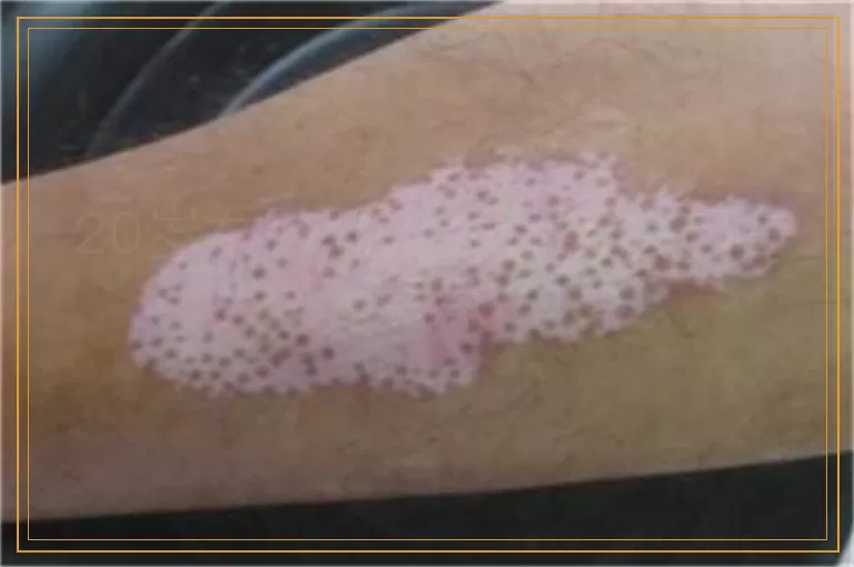 20岁女孩脸上为什么会起白点点