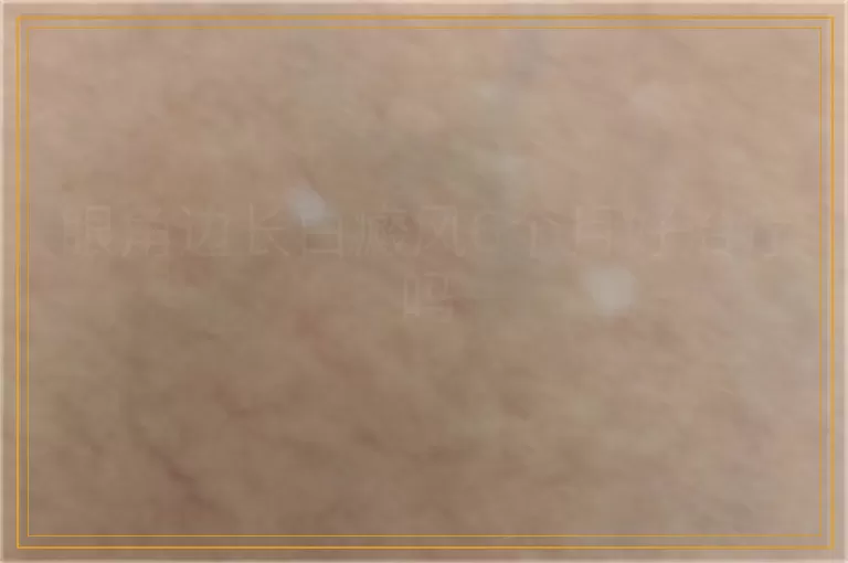 眼角边长白癜风6个月好治疗吗