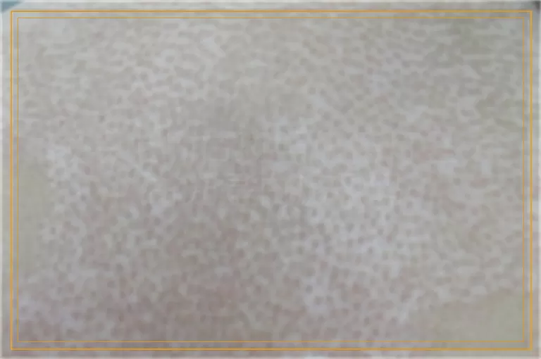 额头上的白斑照伍德灯呈荧白光是白癜风吗