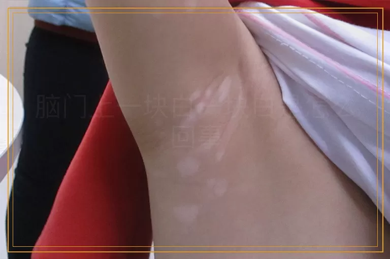 脑门上一块白一块白是怎么回事