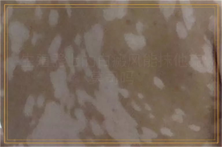 生殖器上的白癜风能抹他克莫司吗