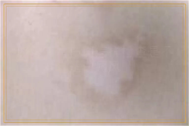 胳膊有片白斑怎样检查是不是白癜风