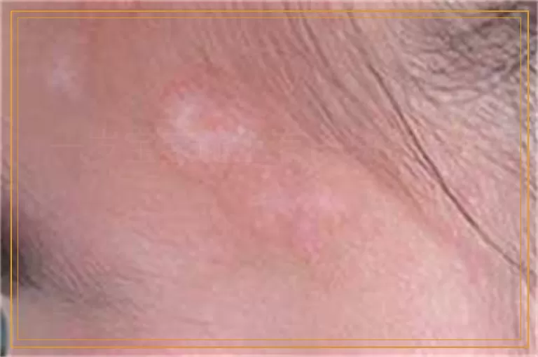 一岁宝宝腿上有一块白是什么