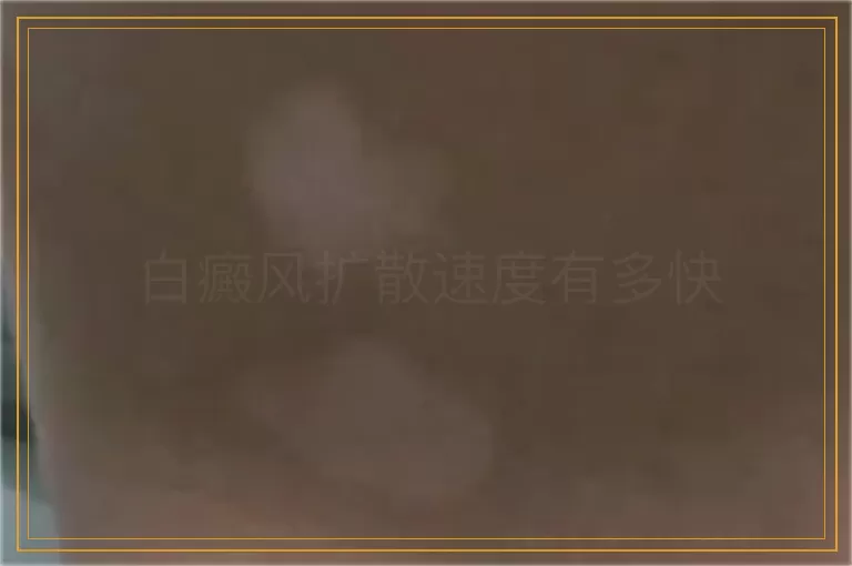 白癜风扩散速度有多快