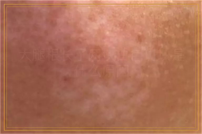 大腿根长了两块白色斑块是什么原因