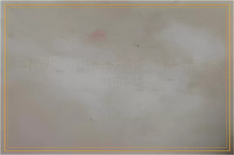 白癜风308准分子激光后起水泡如何处理