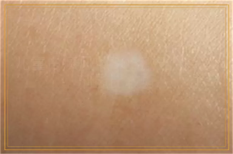 儿童白癜风照308激光用多大剂量比较好