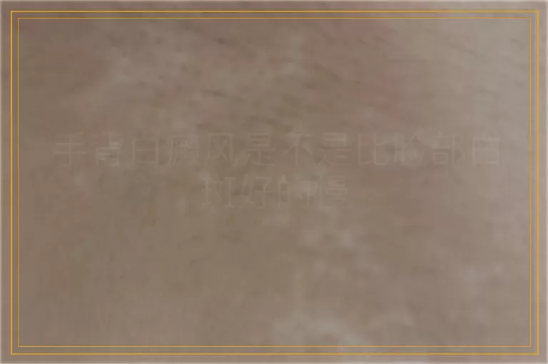 手背白癜风是不是比脸部白斑好的慢