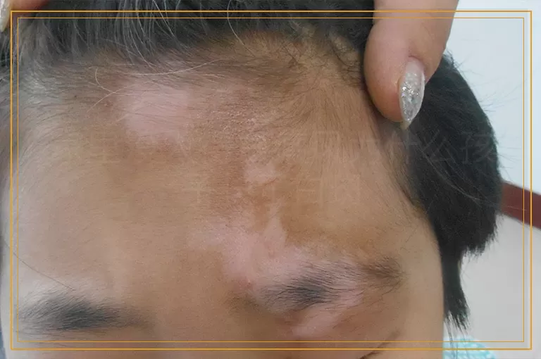 家里没人得白癜风为什么孩子长了白斑