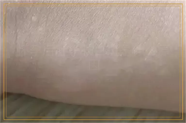 怀孕后肚子长白斑是什么原因