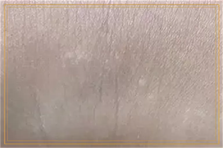 白癜风在伍德灯下是什么颜色的